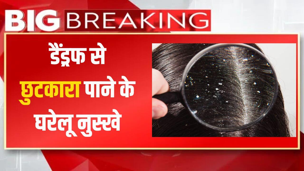 Remedies for Dandruff